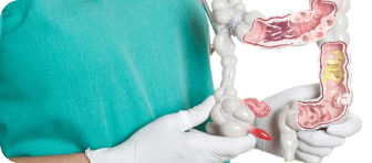 Cirujano mostrando modelo del colon para cirugía de cáncer en CDMX