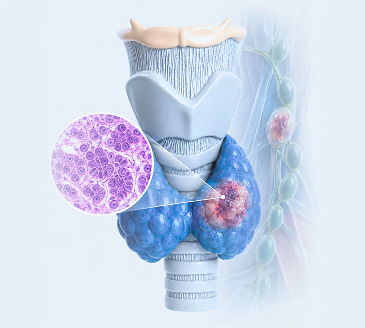 Valoración de un diagnóstico confirmado de cáncer de tiroides