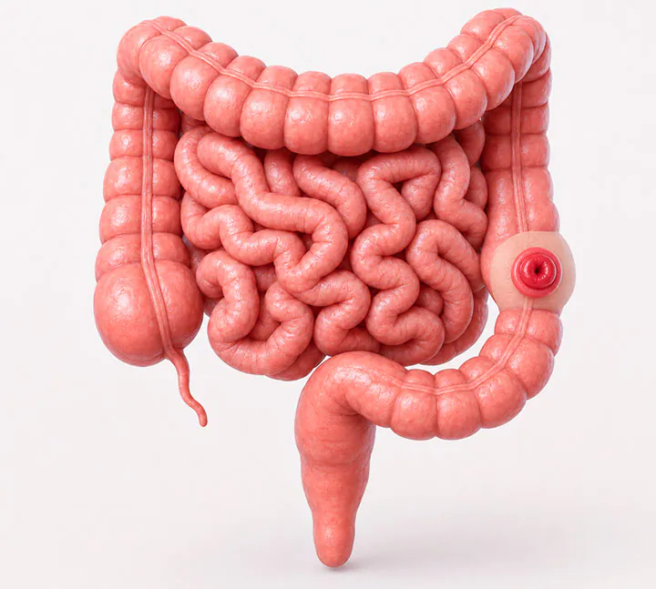 Modelo anatómico de una colostomía descendente