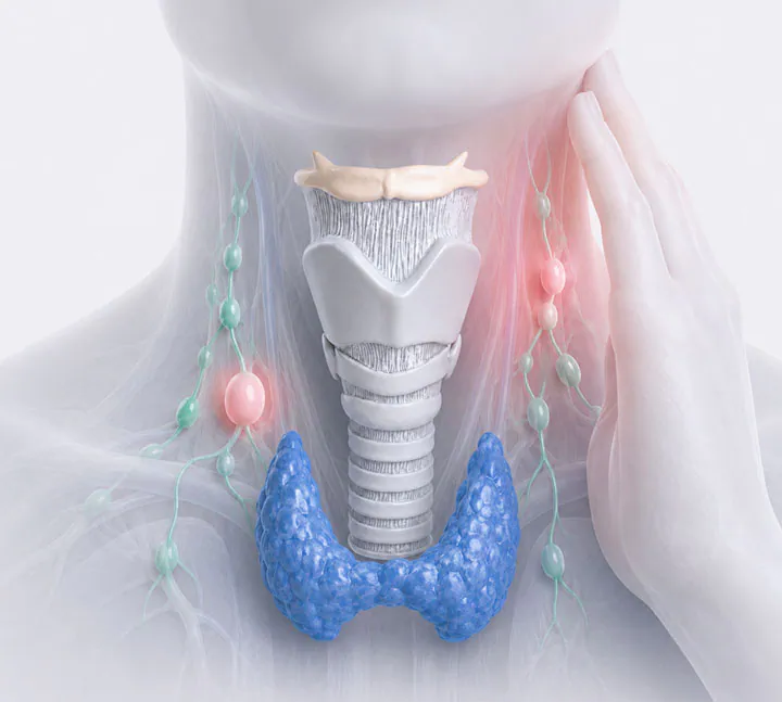 Ganglios sospechosos en el cuello asociados al cáncer de tiroides