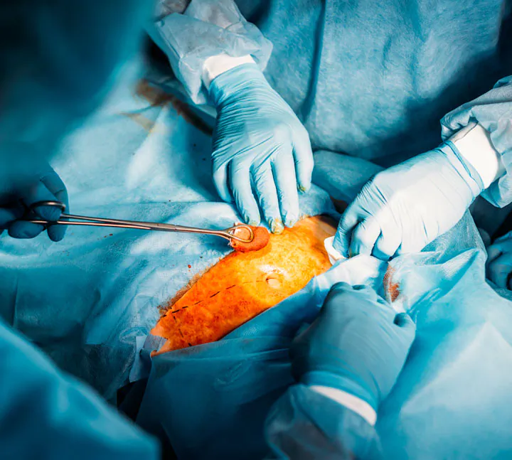 Equipo médico durante una cirugía oncológica de colon